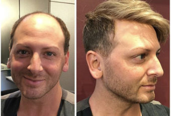 Non-Surgical Hair Replacement